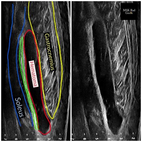 what test shows muscle tears|mri muscle strain vs tear.